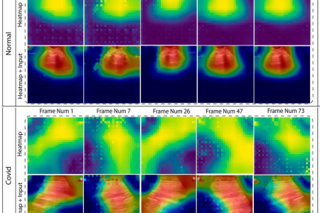 Automated diagnosis of respiratory diseases from lung ultrasound videos ensuring XAI: an innovative hybrid model approach.